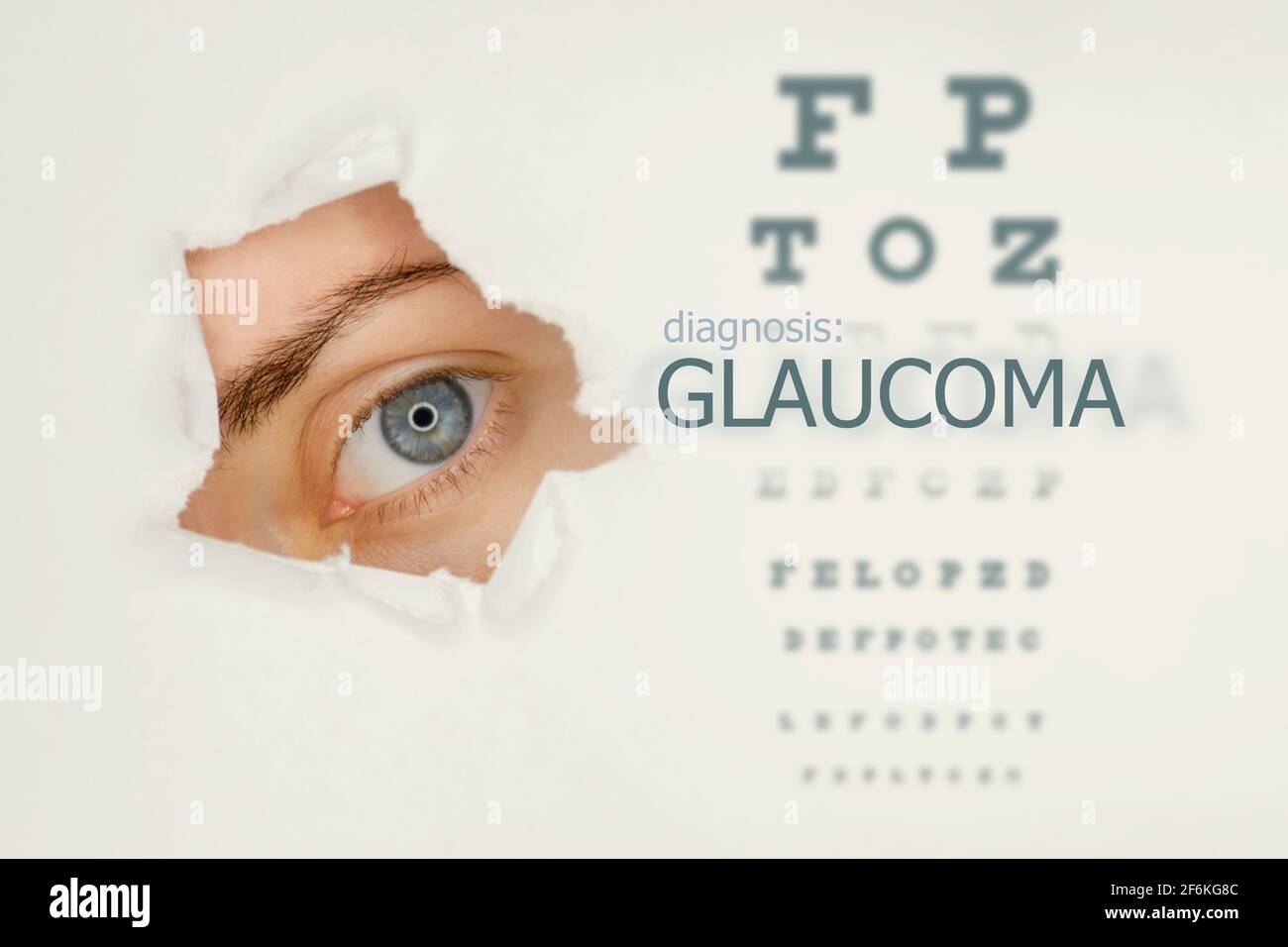 Woman`s eye looking trough teared hole in paper, eye test and word Glaucoma on right. Eye disease concept template. Grey background. Stock Photo
